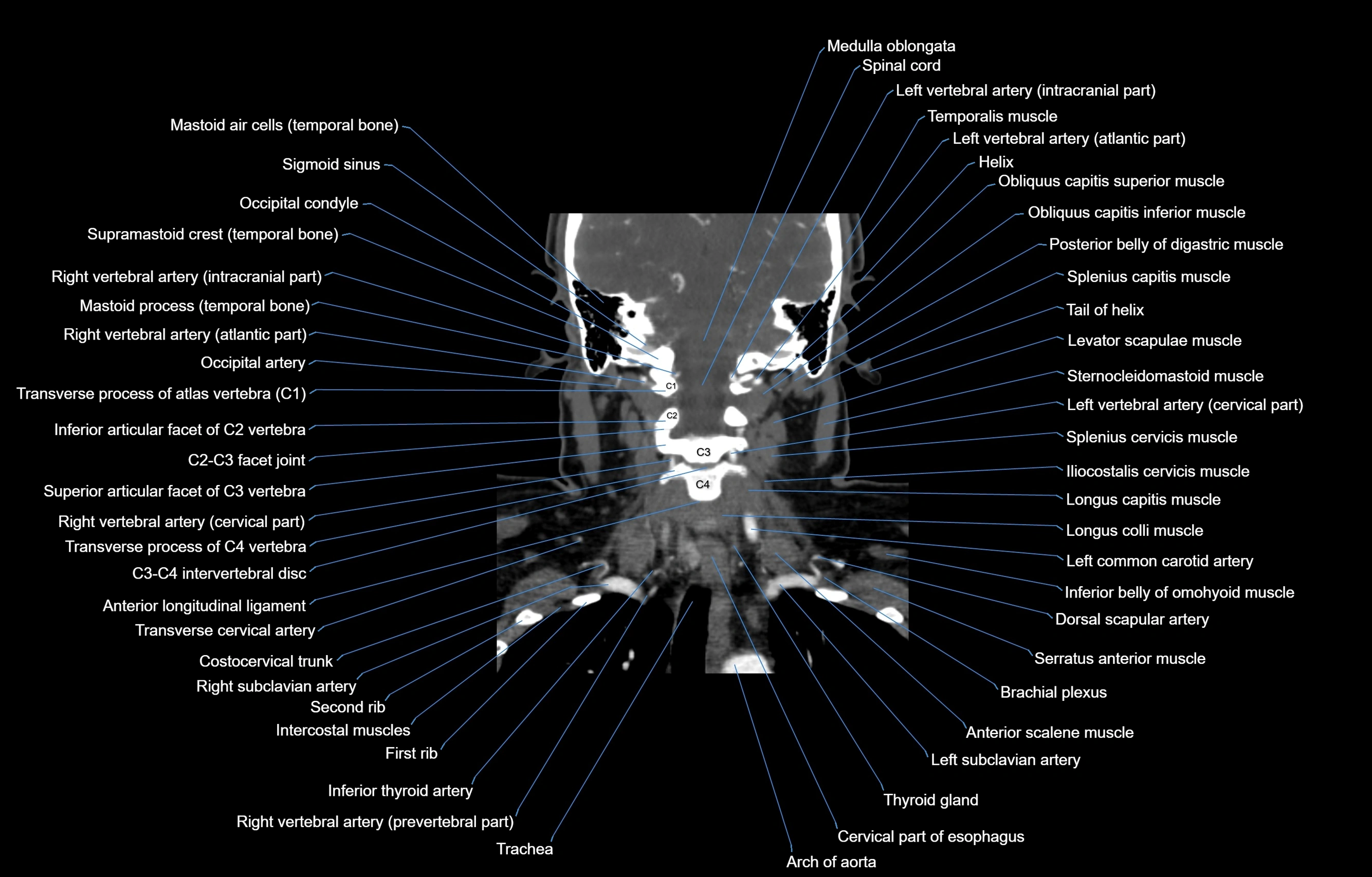 CT Neck coronal  cross sectional anatomy labelled 3D  radiology  image-00042.webp
